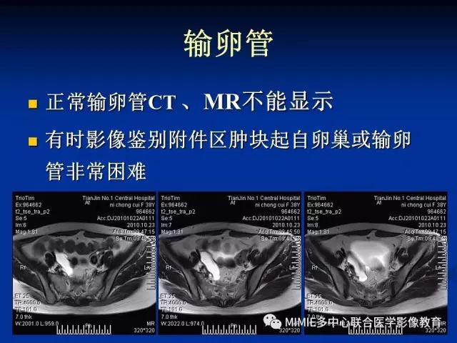 影像PPT - 【PPT】女性生殖系统正常解剖及表现-7
