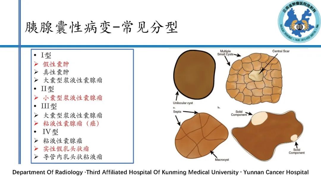 影像PPT - 【PPT】胰腺囊性病变诊断及处理策略-4