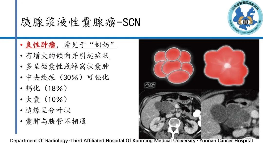 影像PPT - 【PPT】胰腺囊性病变诊断及处理策略-8