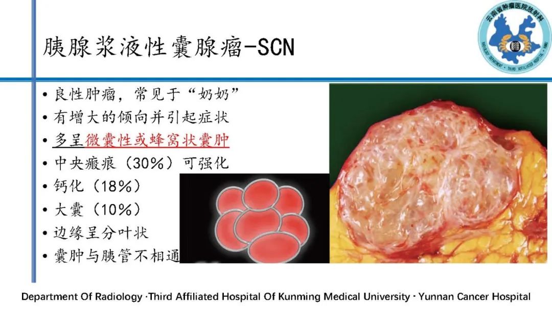 影像PPT - 【PPT】胰腺囊性病变诊断及处理策略-9