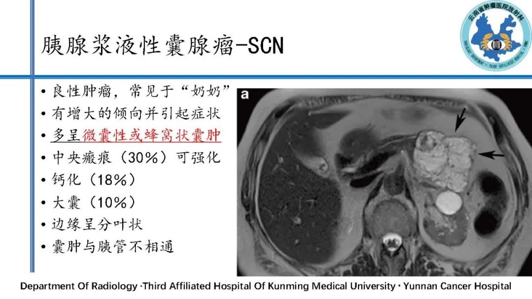 影像PPT - 【PPT】胰腺囊性病变诊断及处理策略-10