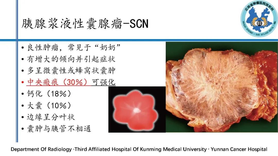 影像PPT - 【PPT】胰腺囊性病变诊断及处理策略-11
