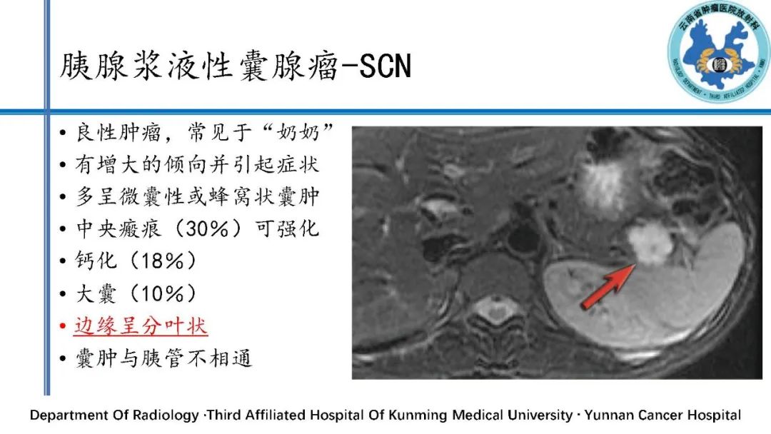 影像PPT - 【PPT】胰腺囊性病变诊断及处理策略-16