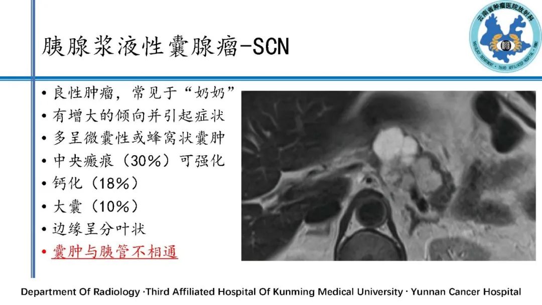 影像PPT - 【PPT】胰腺囊性病变诊断及处理策略-17