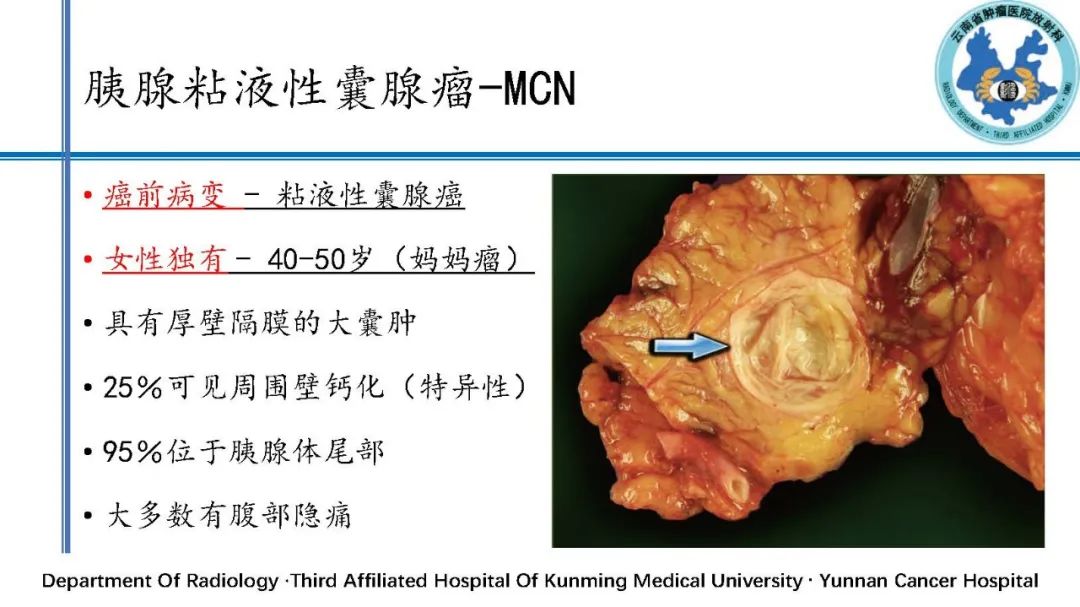 影像PPT - 【PPT】胰腺囊性病变诊断及处理策略-18