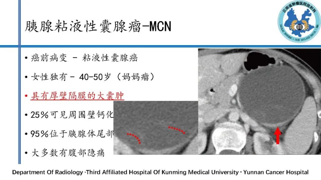 影像PPT - 【PPT】胰腺囊性病变诊断及处理策略-19
