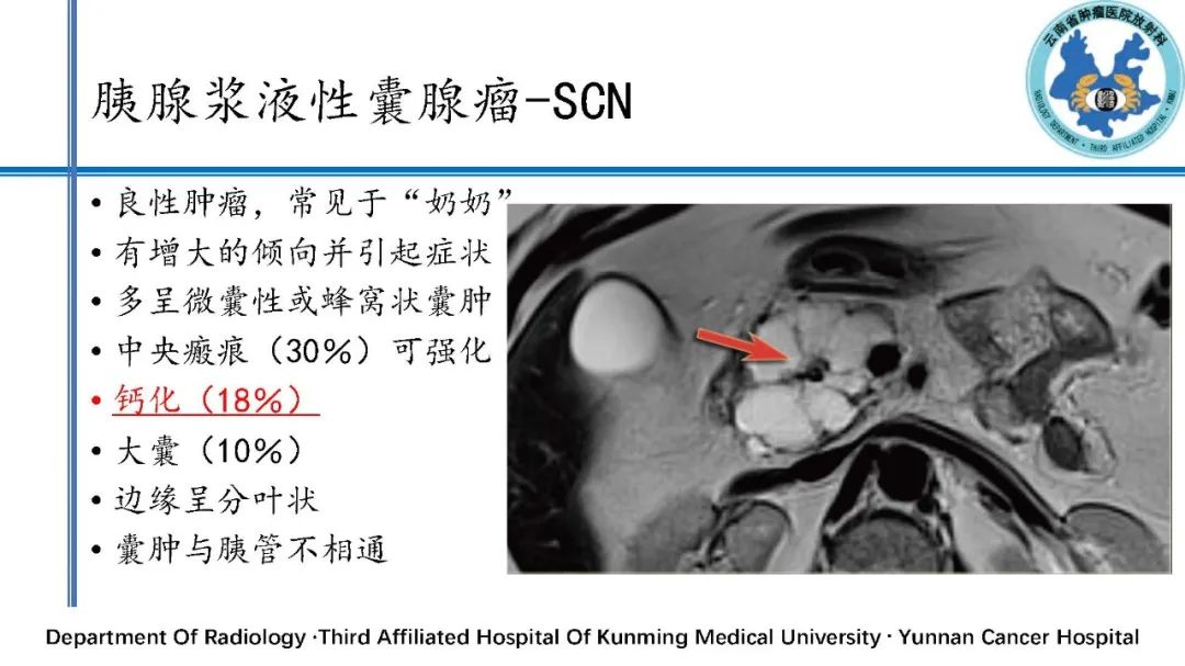 影像PPT - 【PPT】胰腺囊性病变诊断及处理策略-14