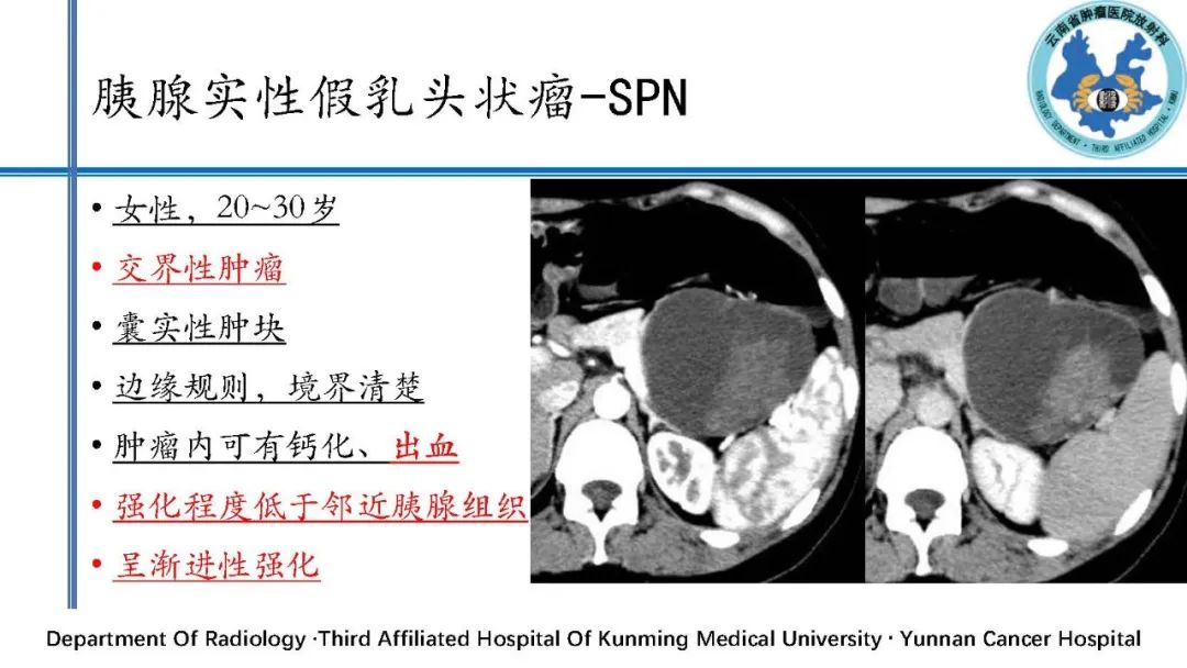 影像PPT - 【PPT】胰腺囊性病变诊断及处理策略-22