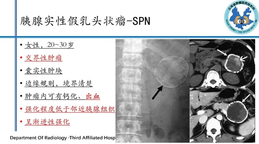 影像PPT - 【PPT】胰腺囊性病变诊断及处理策略-23