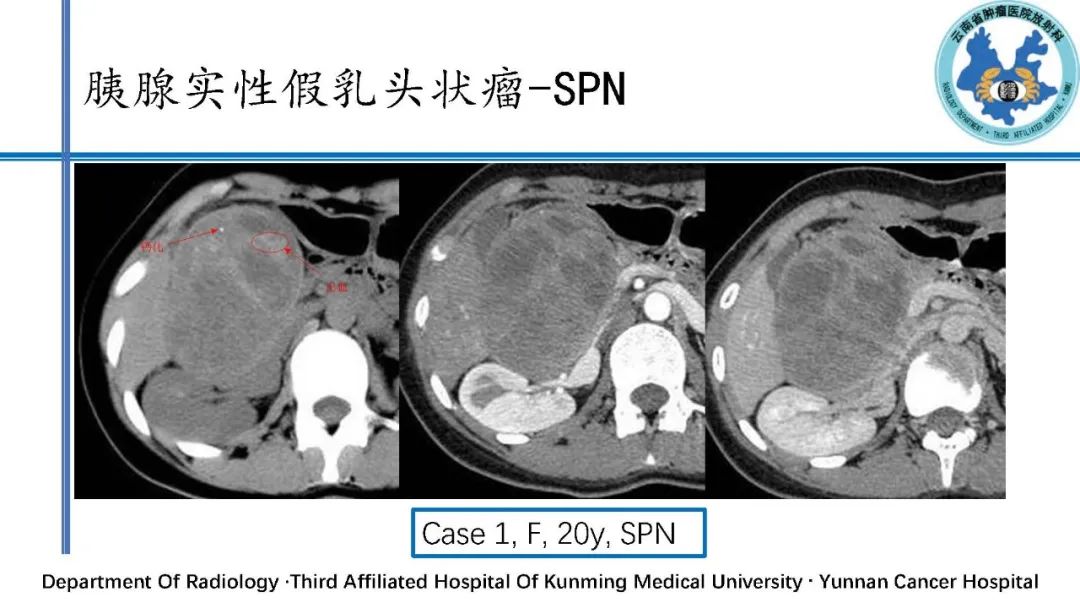 影像PPT - 【PPT】胰腺囊性病变诊断及处理策略-24