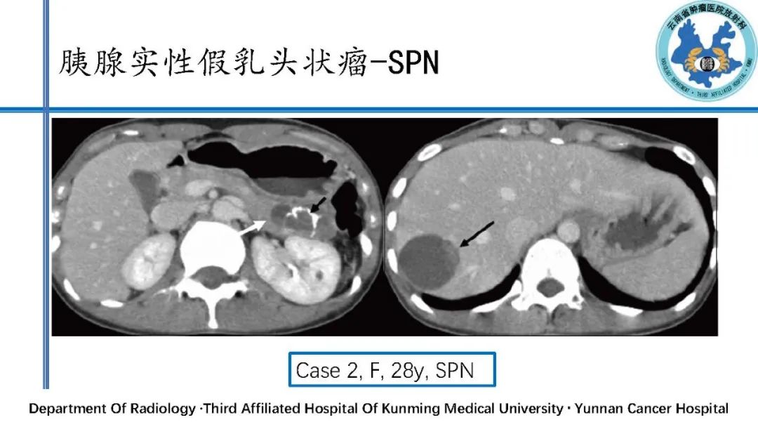 影像PPT - 【PPT】胰腺囊性病变诊断及处理策略-25