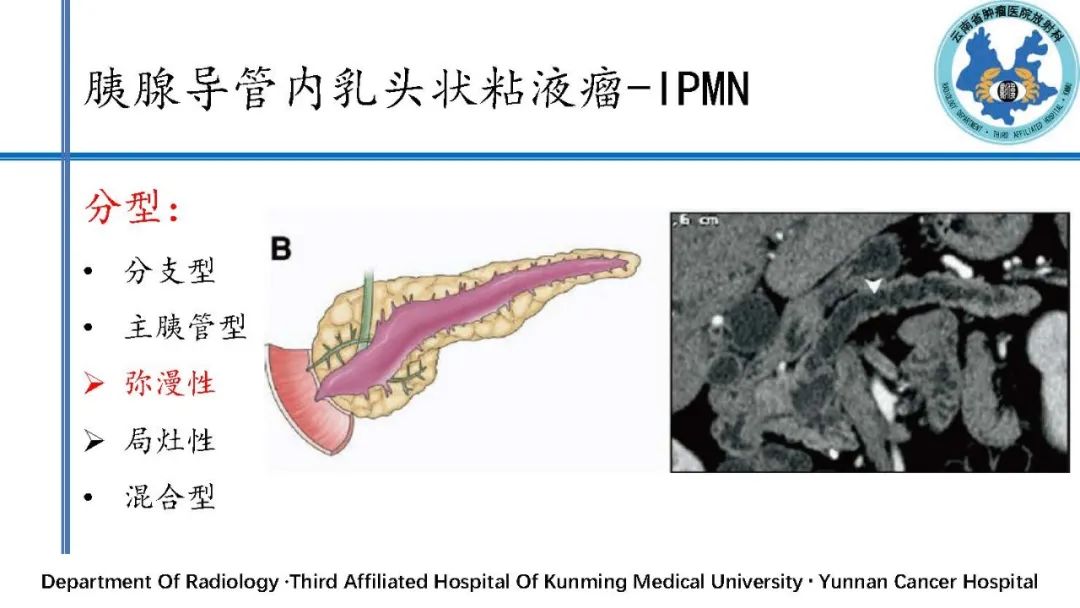 影像PPT - 【PPT】胰腺囊性病变诊断及处理策略-29