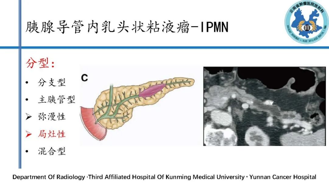 影像PPT - 【PPT】胰腺囊性病变诊断及处理策略-30
