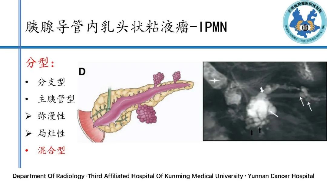 影像PPT - 【PPT】胰腺囊性病变诊断及处理策略-31