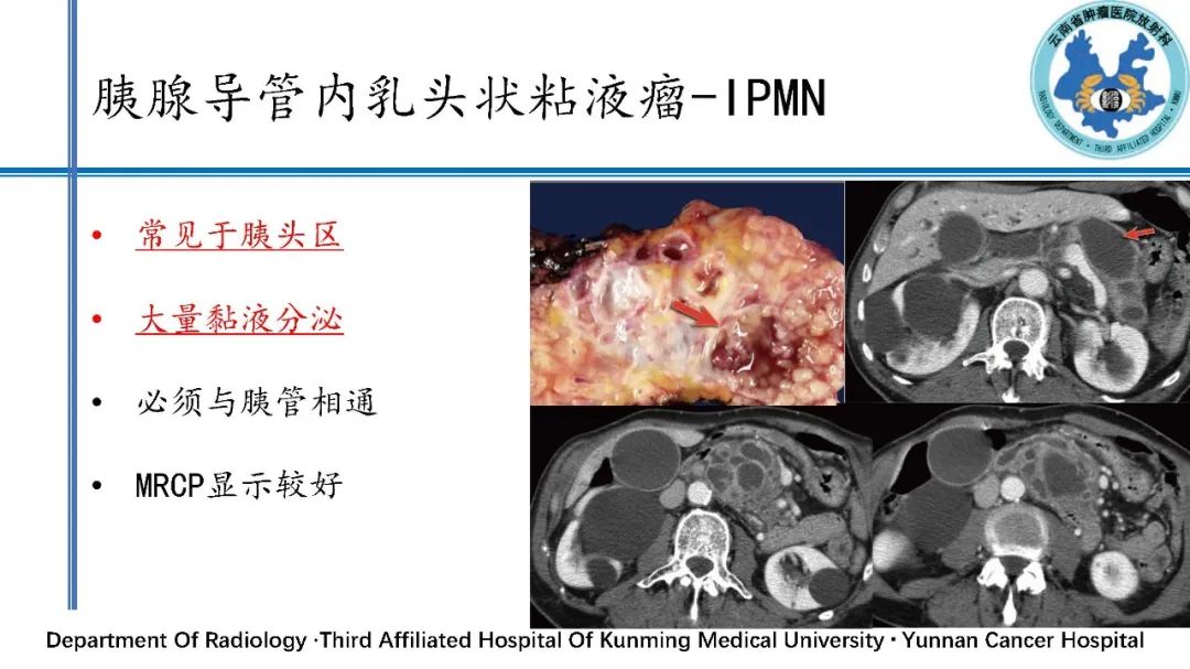 影像PPT - 【PPT】胰腺囊性病变诊断及处理策略-32
