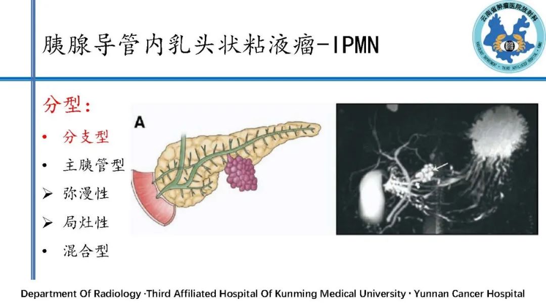 影像PPT - 【PPT】胰腺囊性病变诊断及处理策略-28