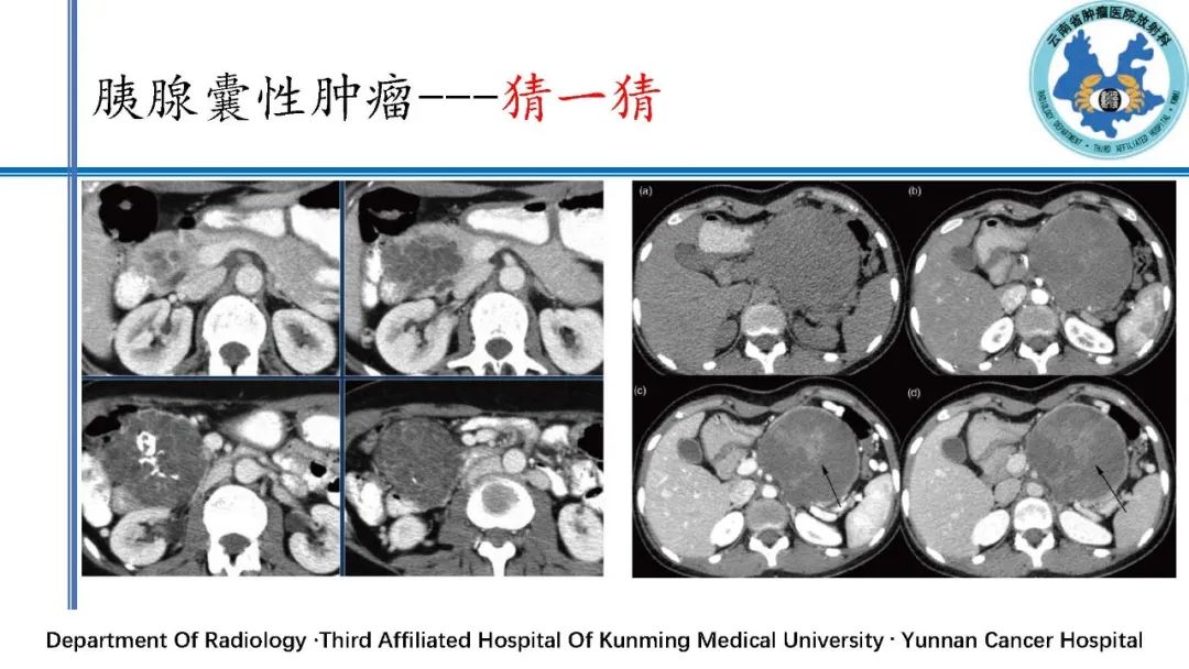 影像PPT - 【PPT】胰腺囊性病变诊断及处理策略-50