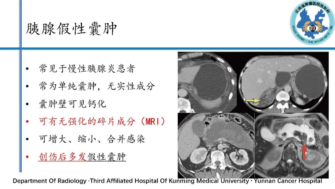 影像PPT - 【PPT】胰腺囊性病变诊断及处理策略-1
