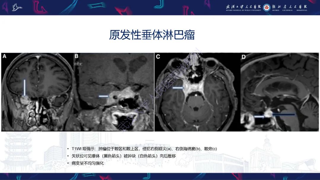 影像PPT - 【PPT】鞍区少见占位影像诊断-10