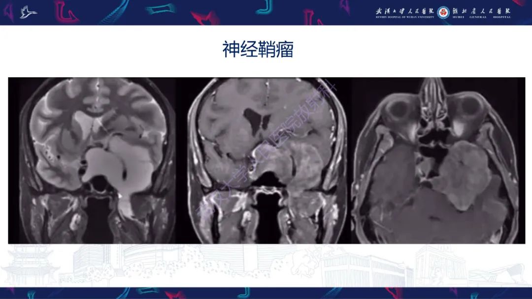 影像PPT - 【PPT】鞍区少见占位影像诊断-13