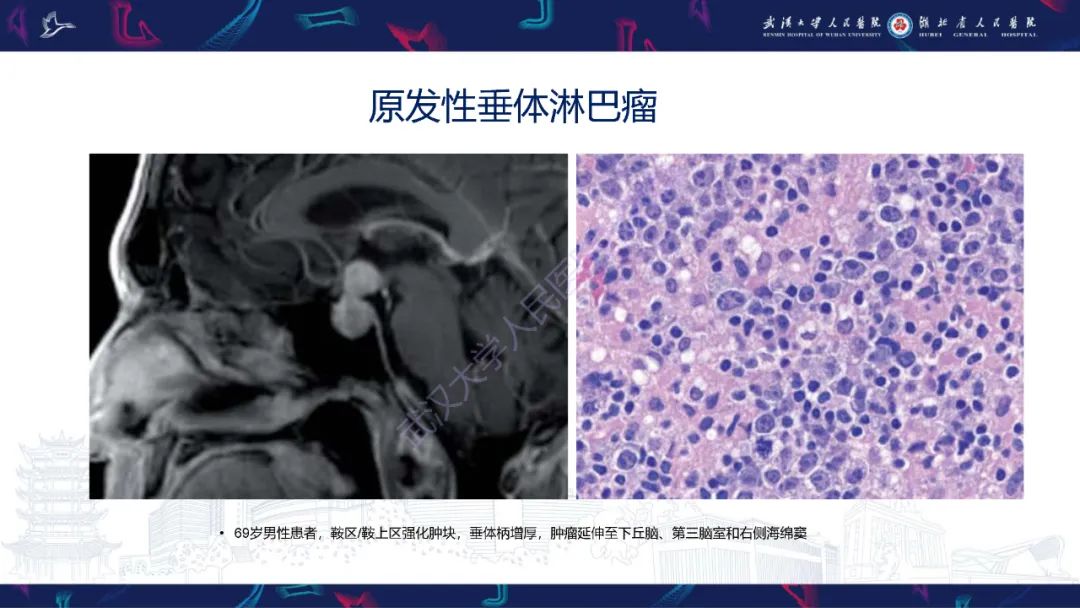 影像PPT - 【PPT】鞍区少见占位影像诊断-11
