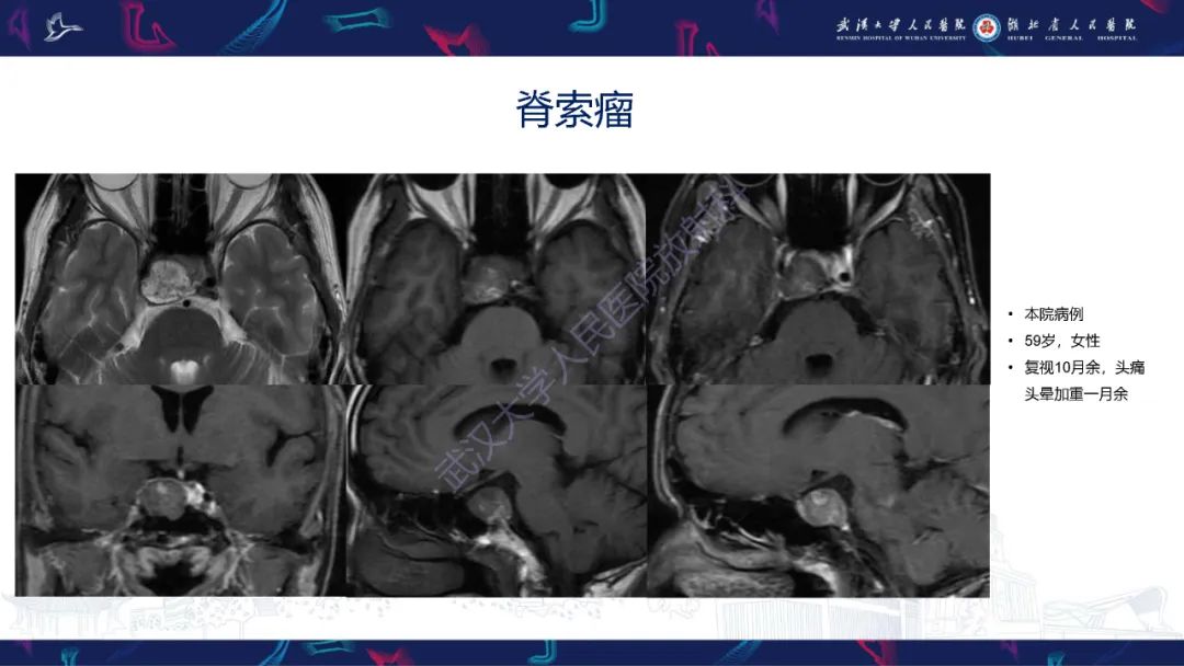 影像PPT - 【PPT】鞍区少见占位影像诊断-15
