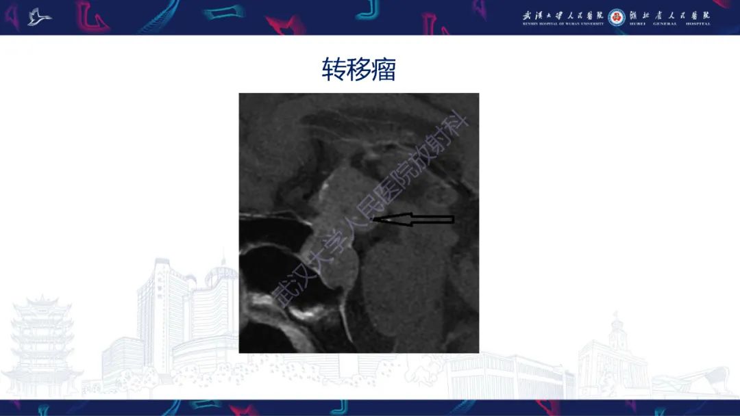 影像PPT - 【PPT】鞍区少见占位影像诊断-17