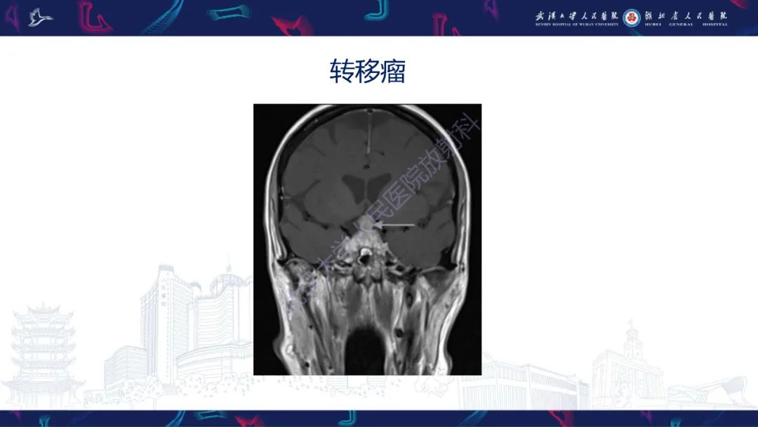 影像PPT - 【PPT】鞍区少见占位影像诊断-18