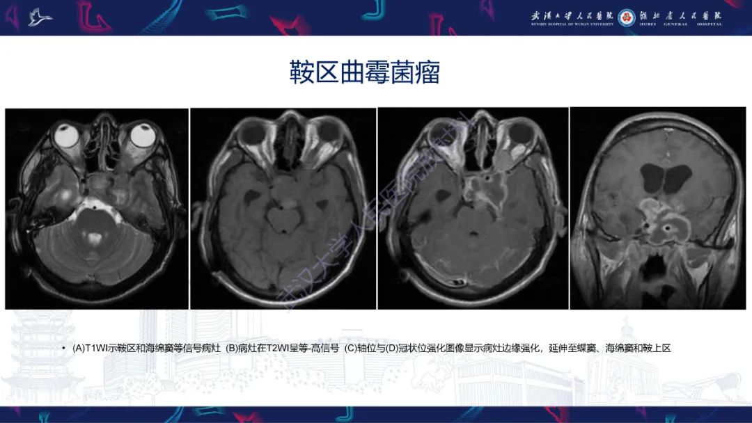 影像PPT - 【PPT】鞍区少见占位影像诊断-23