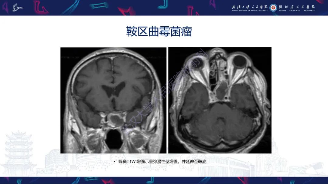 影像PPT - 【PPT】鞍区少见占位影像诊断-24