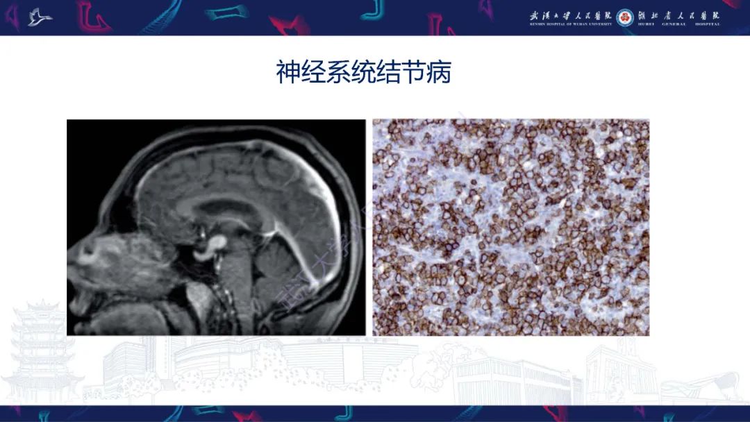 影像PPT - 【PPT】鞍区少见占位影像诊断-21