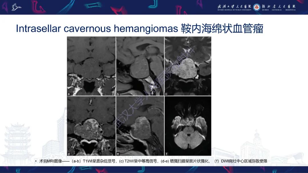 影像PPT - 【PPT】鞍区少见占位影像诊断-26