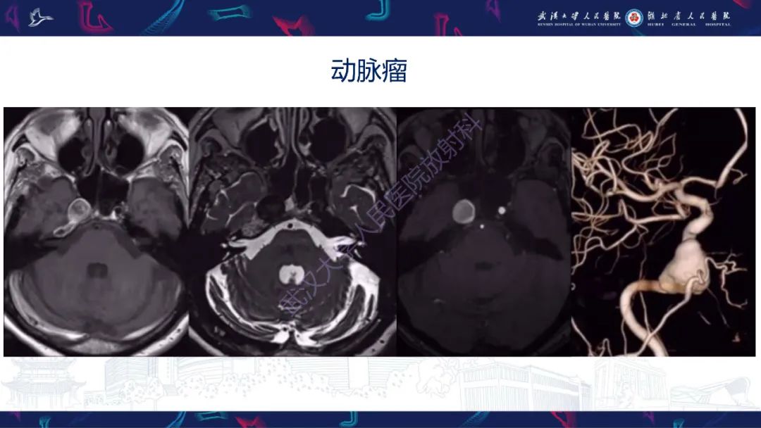 影像PPT - 【PPT】鞍区少见占位影像诊断-29