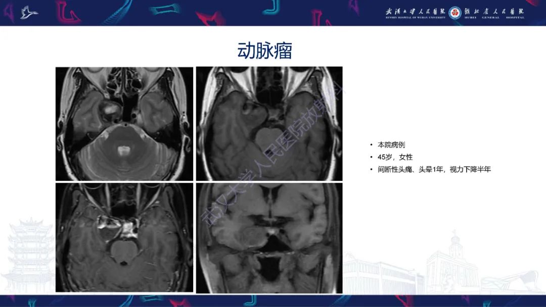 影像PPT - 【PPT】鞍区少见占位影像诊断-28