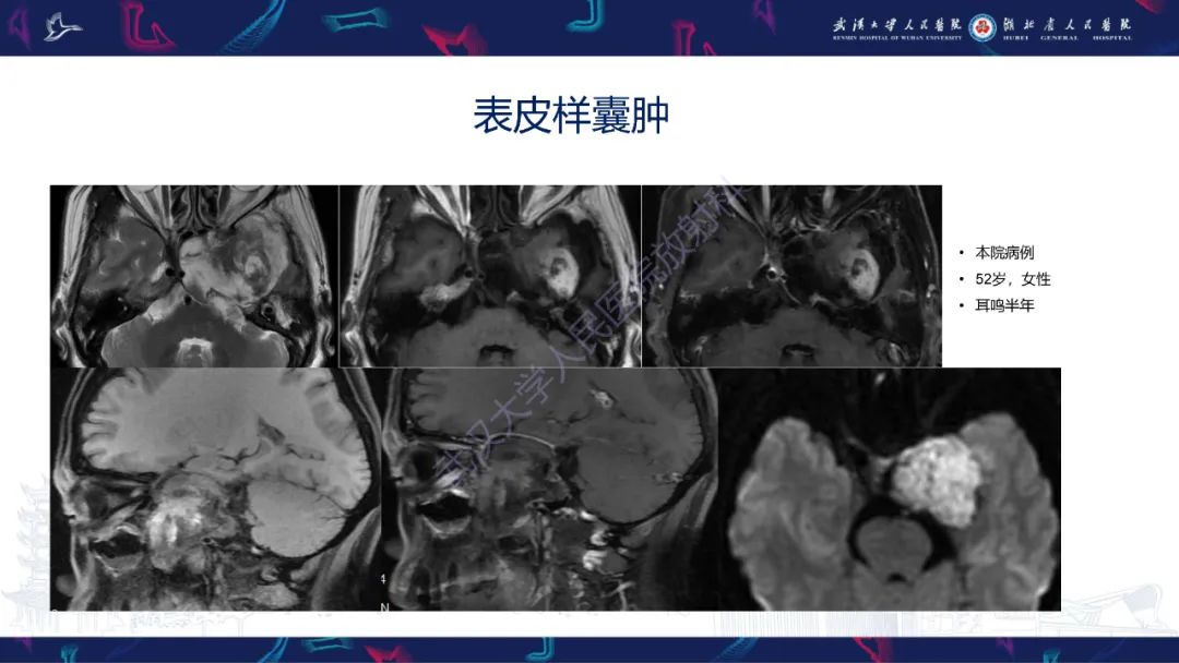影像PPT - 【PPT】鞍区少见占位影像诊断-30