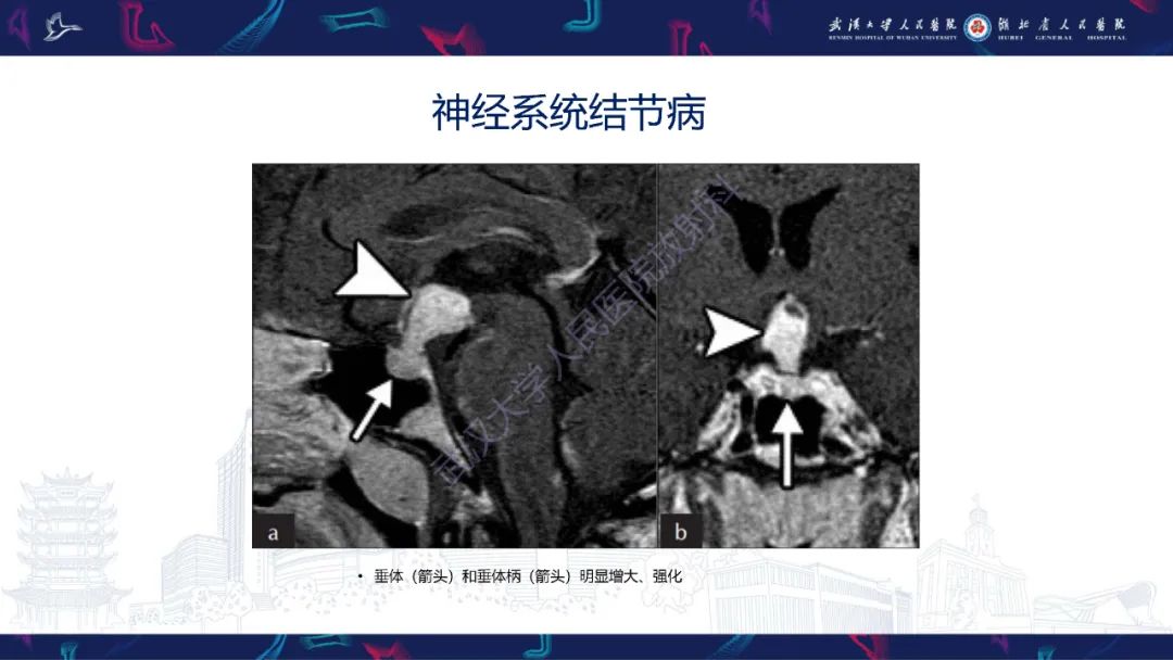 影像PPT - 【PPT】鞍区少见占位影像诊断-2