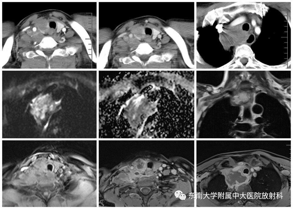 影像PPT - 【PPT】甲状腺乳头状癌的影像诊断-1