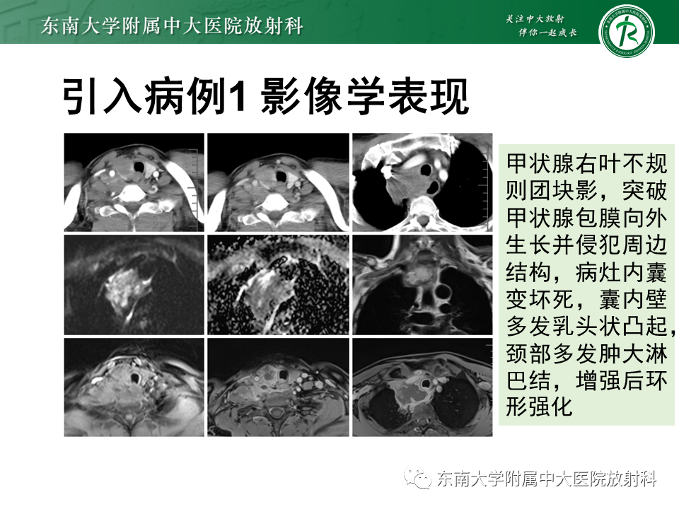 影像PPT - 【PPT】甲状腺乳头状癌的影像诊断-2