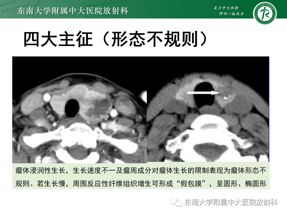 影像PPT - 【PPT】甲状腺乳头状癌的影像诊断-14
