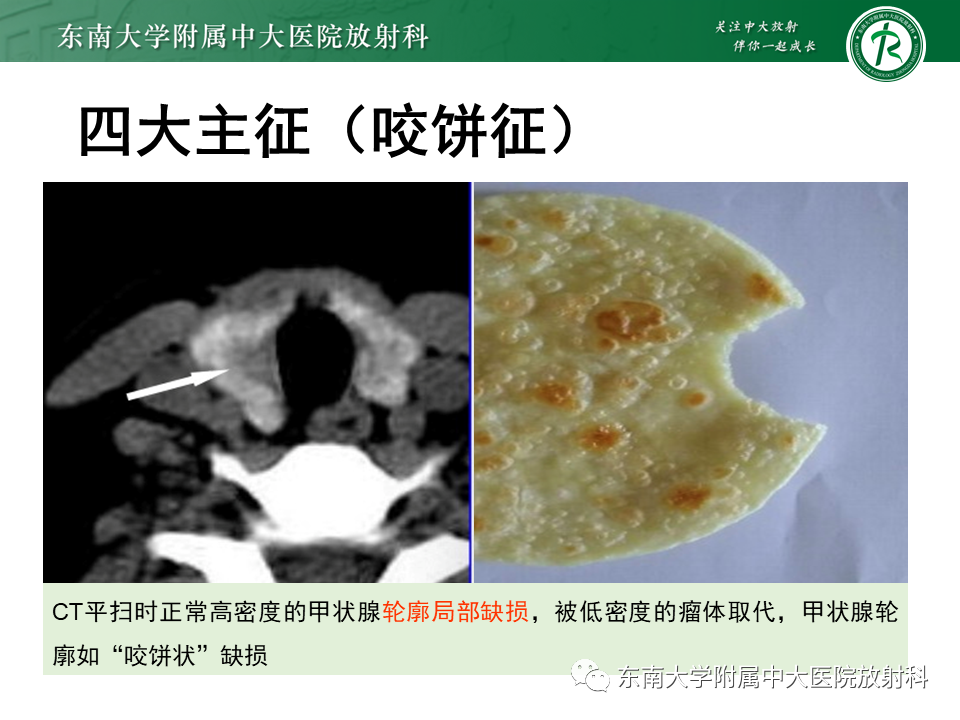 影像PPT - 【PPT】甲状腺乳头状癌的影像诊断-15