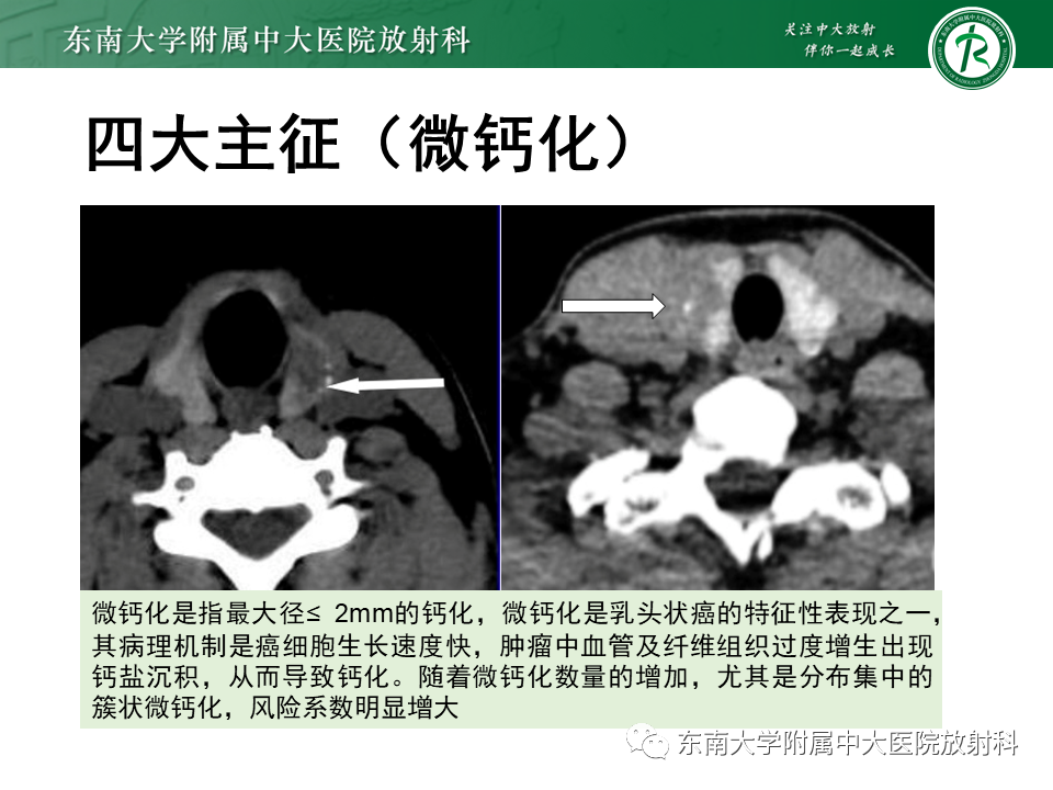 影像PPT - 【PPT】甲状腺乳头状癌的影像诊断-16