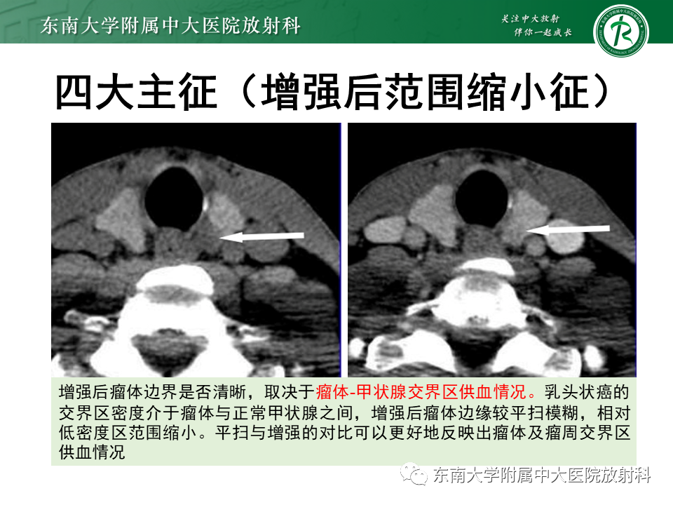 影像PPT - 【PPT】甲状腺乳头状癌的影像诊断-17