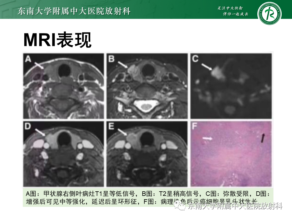 影像PPT - 【PPT】甲状腺乳头状癌的影像诊断-19