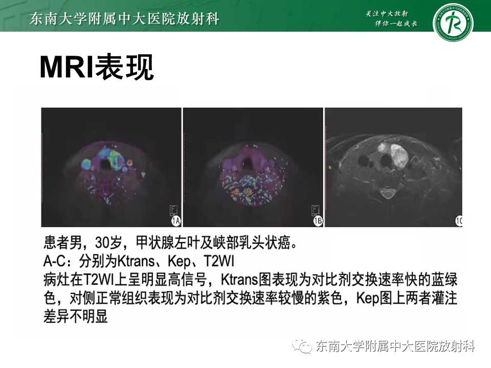 影像PPT - 【PPT】甲状腺乳头状癌的影像诊断-20