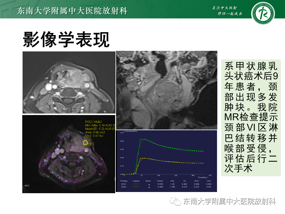 影像PPT - 【PPT】甲状腺乳头状癌的影像诊断-24