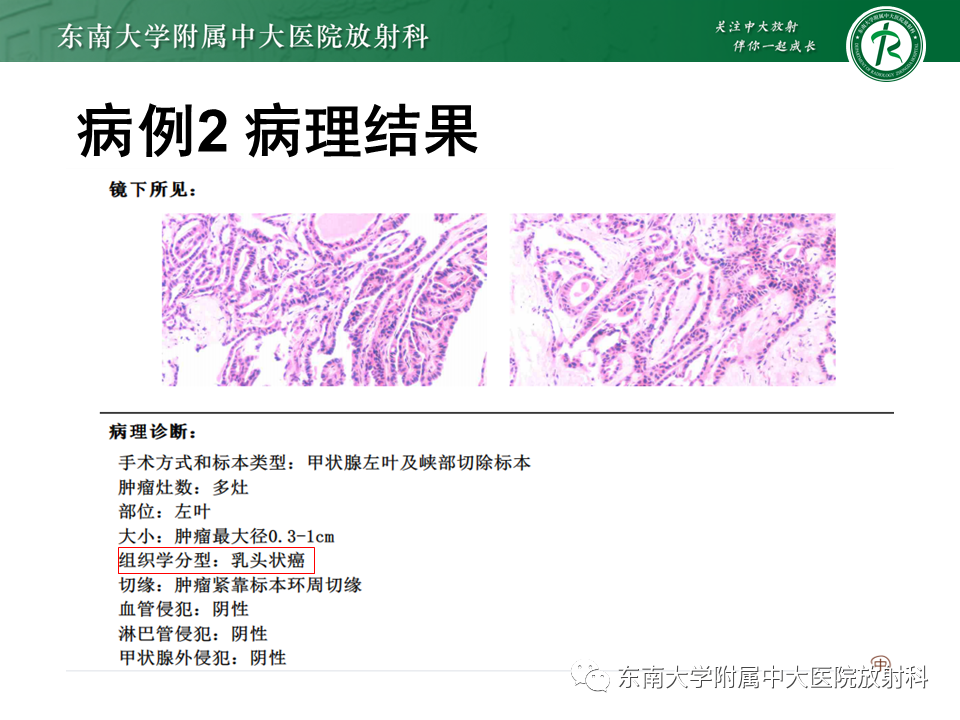 影像PPT - 【PPT】甲状腺乳头状癌的影像诊断-27