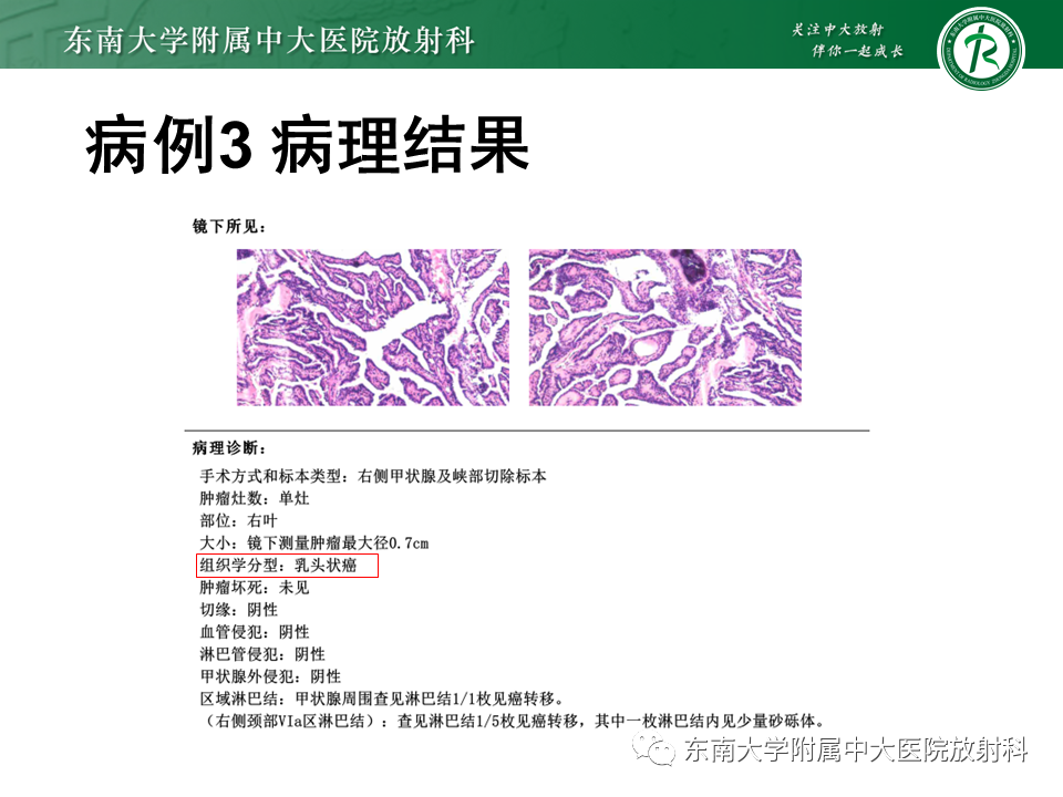 影像PPT - 【PPT】甲状腺乳头状癌的影像诊断-30