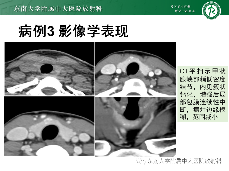 影像PPT - 【PPT】甲状腺乳头状癌的影像诊断-29