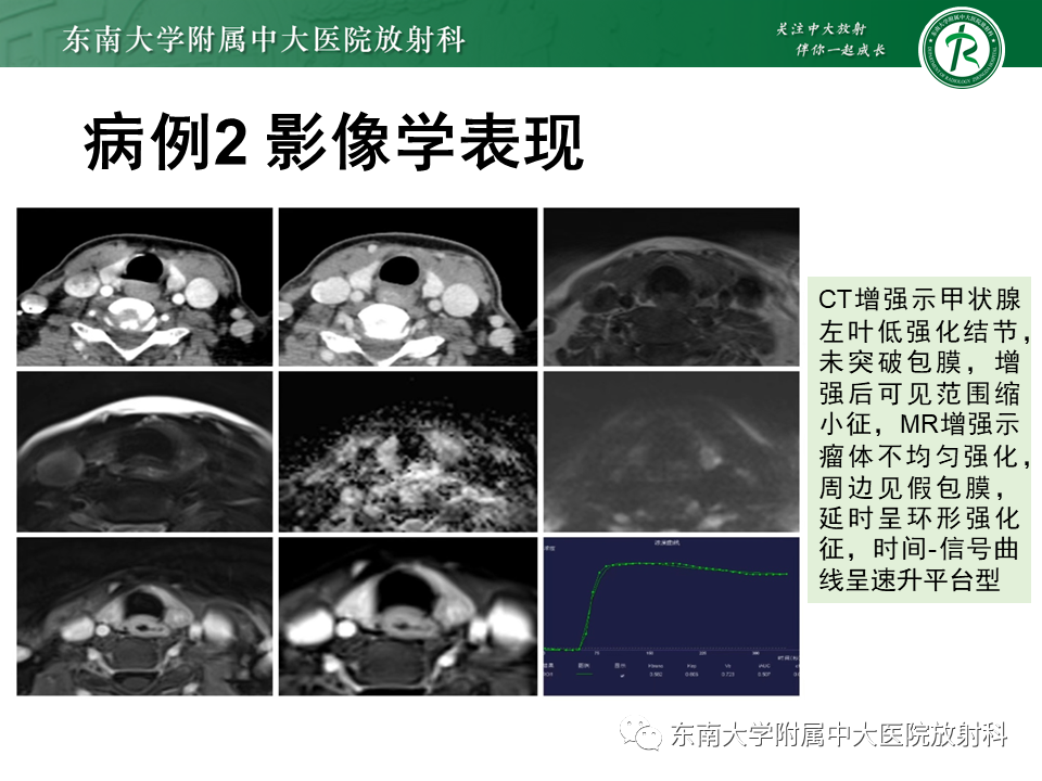 影像PPT - 【PPT】甲状腺乳头状癌的影像诊断-26