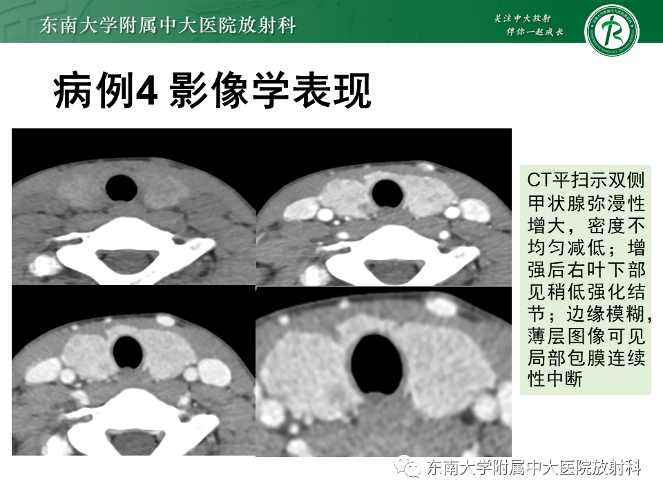 影像PPT - 【PPT】甲状腺乳头状癌的影像诊断-32